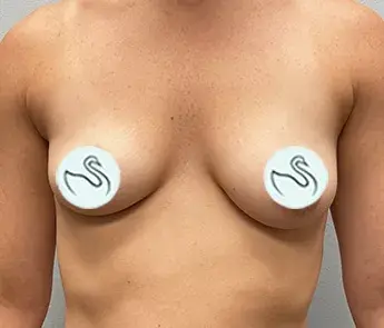 Breast Augmentation before at The Skin Center in Columbus, OH