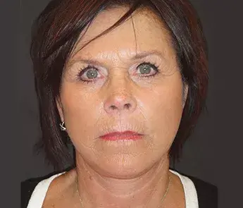 The Skin Center after — Columbus, OH