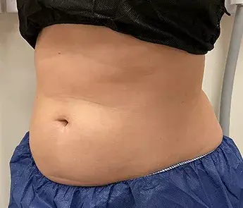 CoolSculpting before at The Skin Center in Columbus, OH