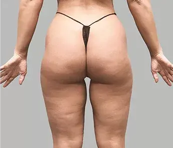 Brazilian Butt Lift before at The Skin Center in Columbus, OH