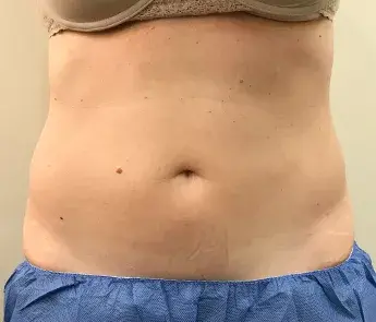 The Skin Center coolsculpting after — Columbus, OH
