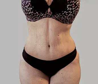 The Skin Center tummy tuck after — Columbus, OH