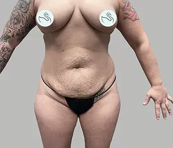 Mini Tummy Tuck before at The Skin Center in Columbus, OH