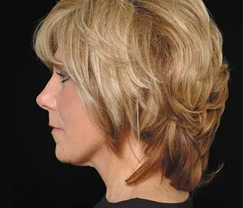 The Skin Center facelift after — Columbus, OH