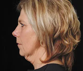 Facelift before at The Skin Center in Columbus, OH
