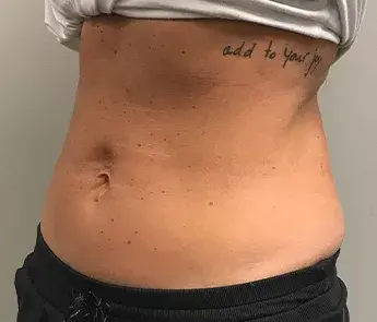 CoolSculpting after at The Skin Center in Columbus, OH