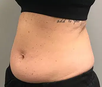 CoolSculpting before at The Skin Center in Columbus, OH