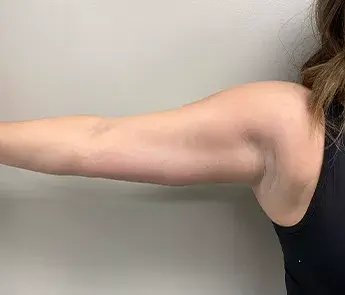 The Skin Center coolsculpting after — Columbus, OH