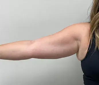 CoolSculpting before at The Skin Center in Columbus, OH