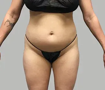 Liposuction before at The Skin Center in Columbus, OH
