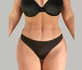 The Skin Center tummy tuck after — Columbus, OH