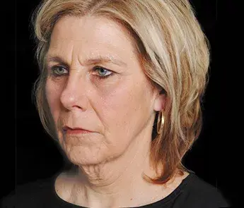 Facelift before at The Skin Center in Columbus, OH