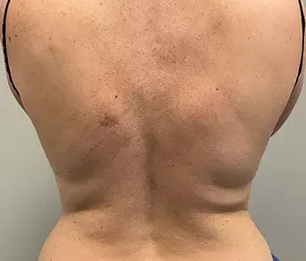 The Skin Center coolsculpting after — Columbus, OH