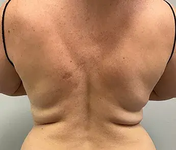 CoolSculpting before at The Skin Center in Columbus, OH