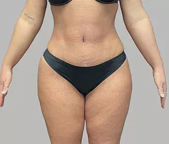 Tummy Tuck after at The Skin Center in Columbus, OH