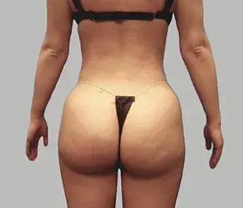 Brazilian Butt Lift after at The Skin Center in Columbus, OH