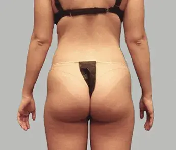Brazilian Butt Lift before at The Skin Center in Columbus, OH