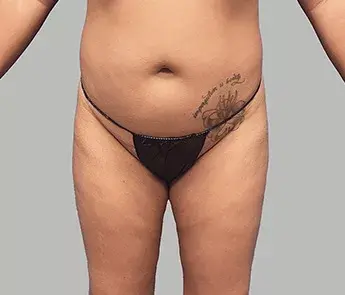 Liposuction before at The Skin Center in Columbus, OH