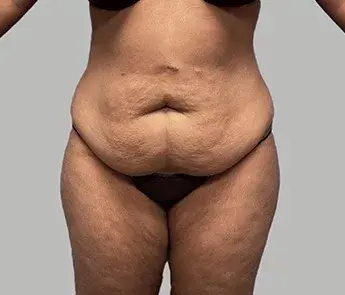 Tummy Tuck before at The Skin Center in Columbus, OH