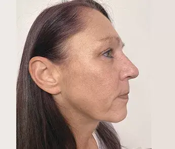 The Skin Center after — Columbus, OH