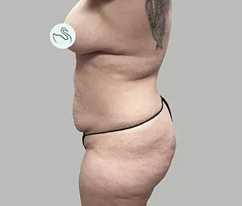 Brazilian Butt Lift before at The Skin Center in Columbus, OH