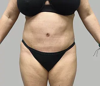 The Skin Center tummy tuck after — Columbus, OH