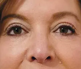 Blepharoplasty after at The Skin Center in Columbus, OH