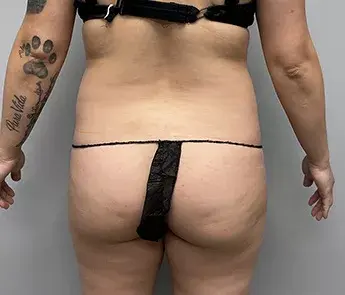 Brazilian Butt Lift before at The Skin Center in Columbus, OH