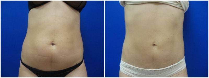Douglas Senderoff, MD, FACS liposuction result — New York, NY