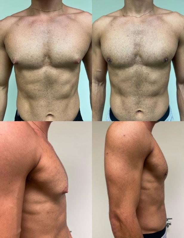 Douglas Senderoff, MD, FACS gynecomastia result — New York, NY