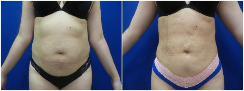 Douglas Senderoff, MD, FACS liposuction result — New York, NY