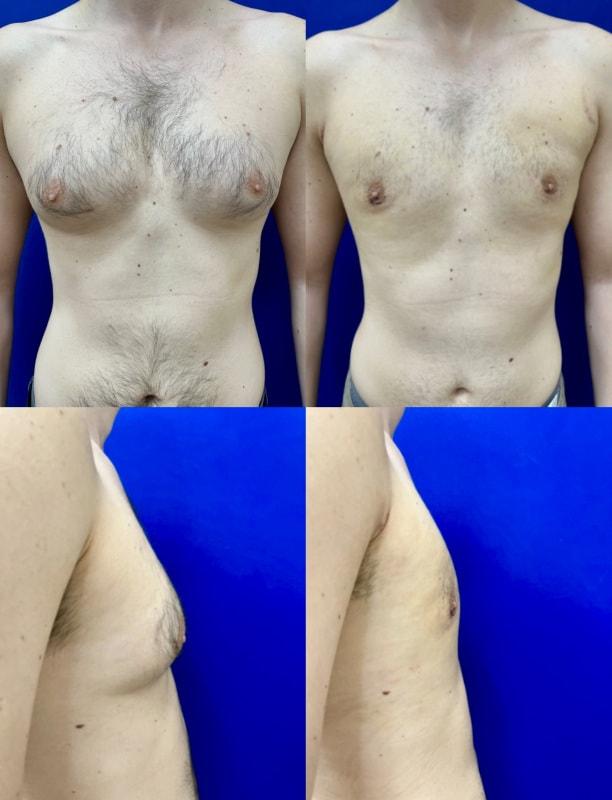Douglas Senderoff, MD, FACS gynecomastia result — New York, NY