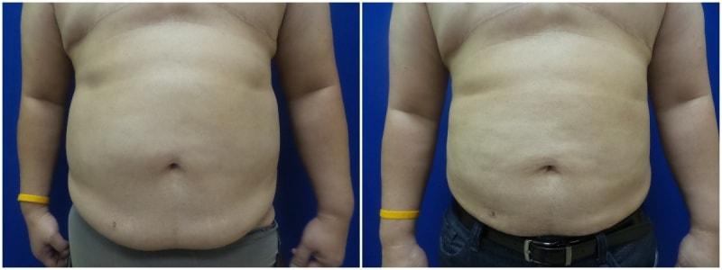 Douglas Senderoff, MD, FACS liposuction result — New York, NY