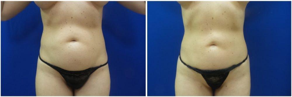 Douglas Senderoff, MD, FACS liposuction result — New York, NY