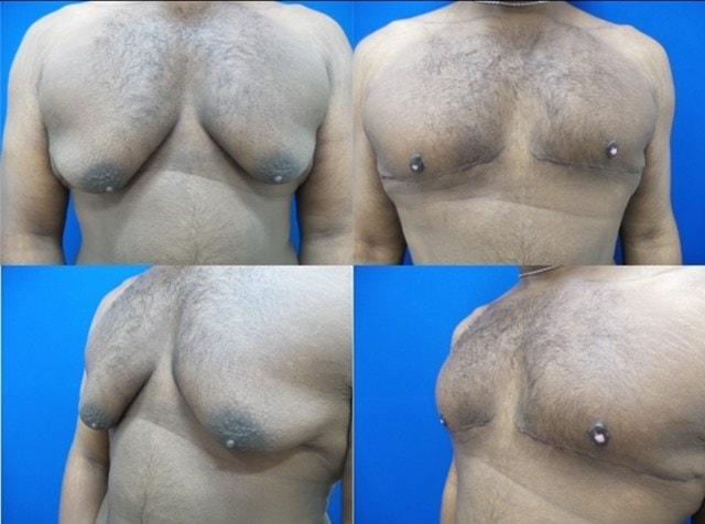 Douglas Senderoff, MD, FACS gynecomastia result — New York, NY