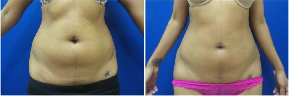 Douglas Senderoff, MD, FACS liposuction result — New York, NY