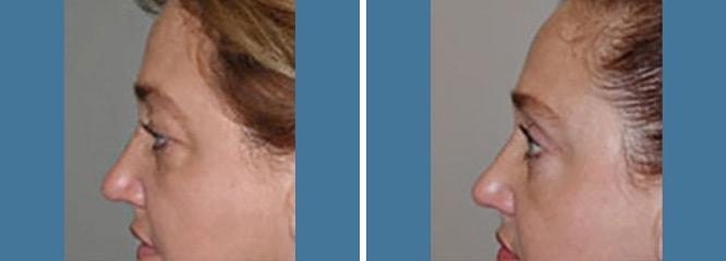 Accurate Aesthetics Plastic Surgery eyelid lift result — Wellesley, MA