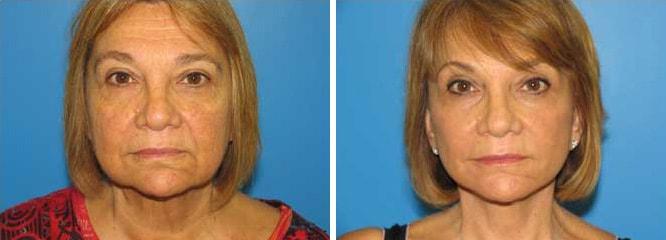 Accurate Aesthetics Plastic Surgery facelift result — Wellesley, MA