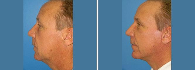 Accurate Aesthetics Plastic Surgery facelift result — Wellesley, MA