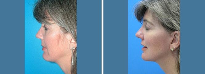 Accurate Aesthetics Plastic Surgery facelift result — Wellesley, MA