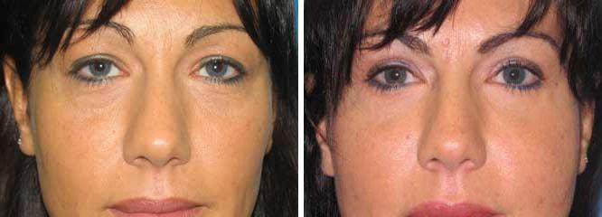 Accurate Aesthetics Plastic Surgery eyelid lift result — Wellesley, MA