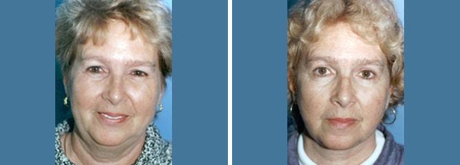 Accurate Aesthetics Plastic Surgery facelift result — Wellesley, MA
