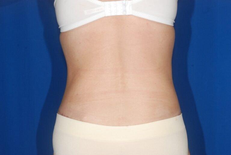 David Bogue, MD Plastic Surgery liposuction after — Boca Raton, FL