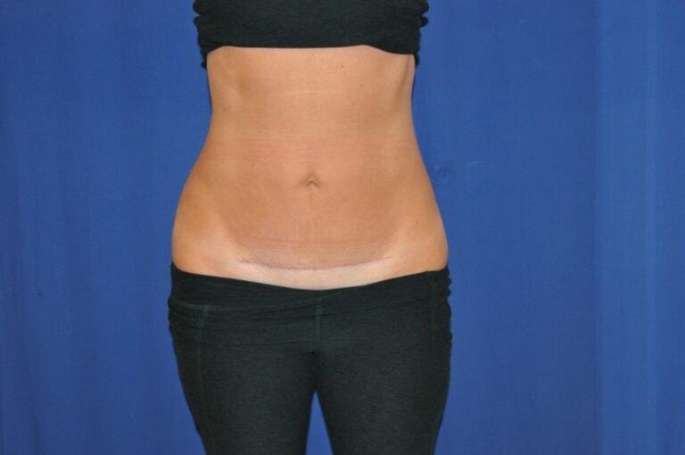 David Bogue, MD Plastic Surgery liposuction after — Boca Raton, FL