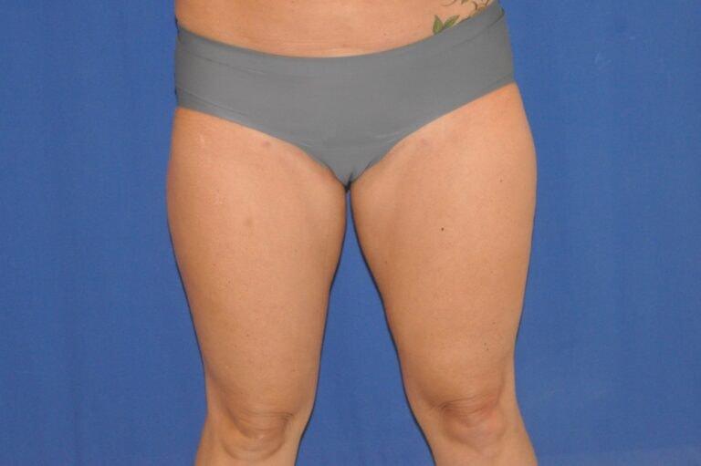 David Bogue, MD Plastic Surgery liposuction after — Boca Raton, FL
