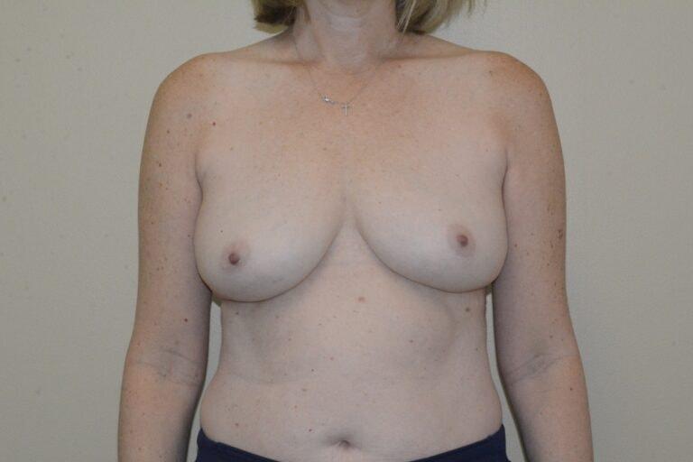 David Bogue, MD Plastic Surgery breast implant removal after — Boca Raton, FL