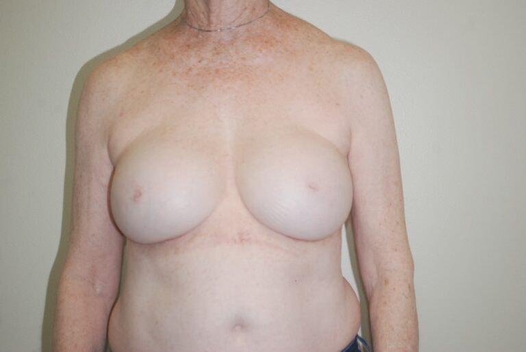 David Bogue, MD Plastic Surgery breast augmentation revision after — Boca Raton, FL