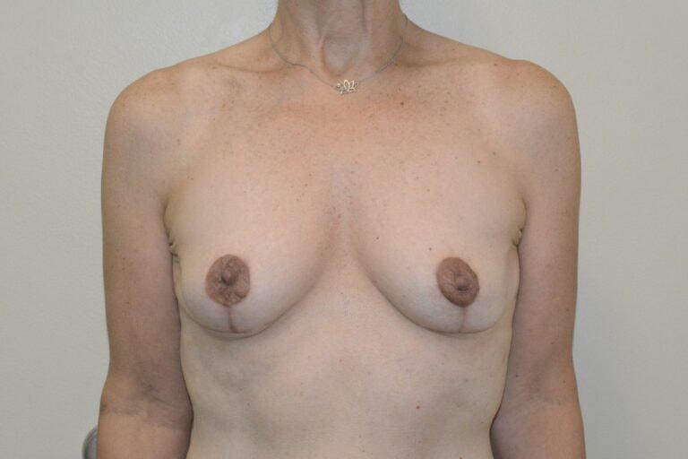 David Bogue, MD Plastic Surgery breast implant removal after — Boca Raton, FL