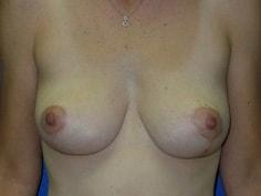 Jon Paul Trevisani, MD breast lift after — Maitland, FL