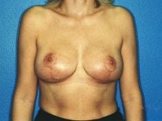 Jon Paul Trevisani, MD breast lift after — Maitland, FL